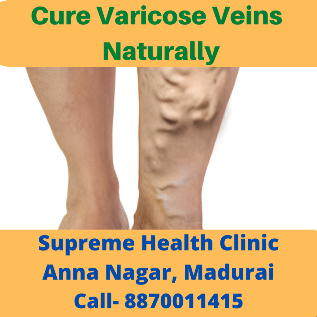 varicose vain treatment Madurai  