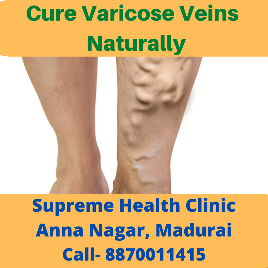 varicose vain